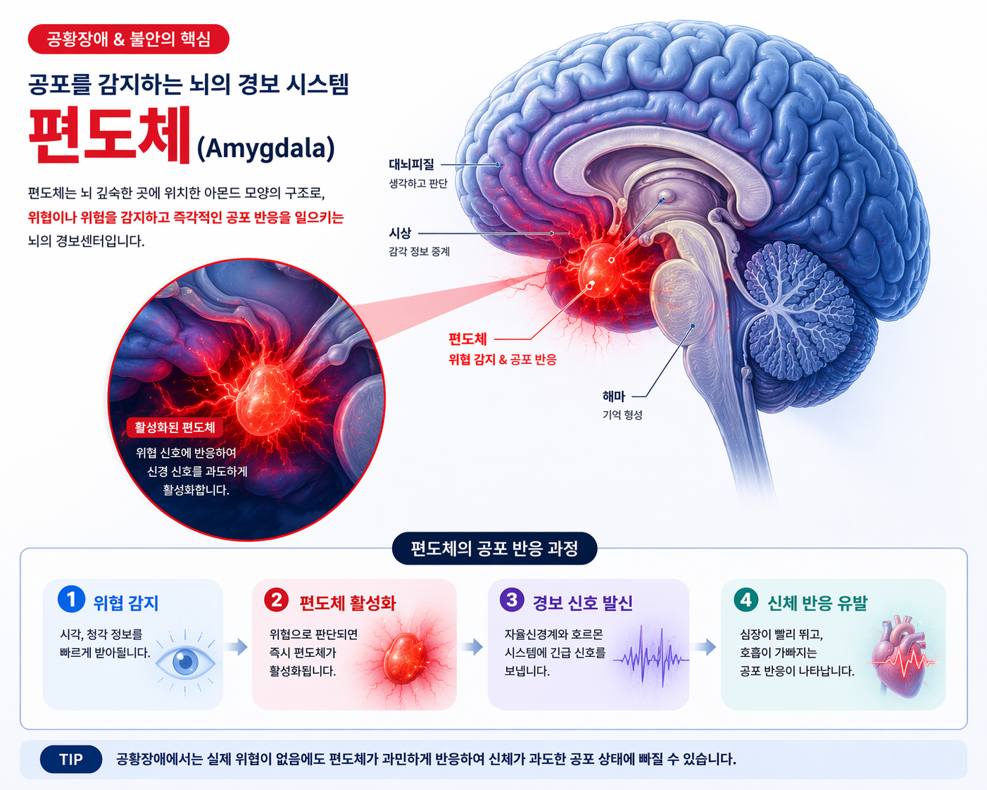 공황장애에서 편도체 과활성을 설명하는 뇌 이미지